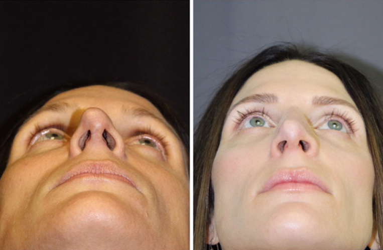 Rhinoplasty Before And After Patient 22 Case 5522 Closeup View