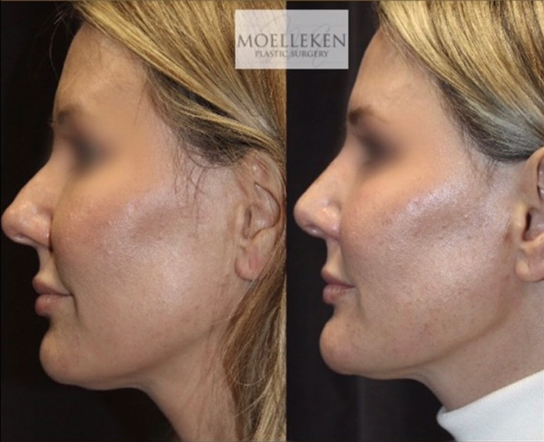 Rhinoplasty Before And After Patient 23 Case 5523 Side View
