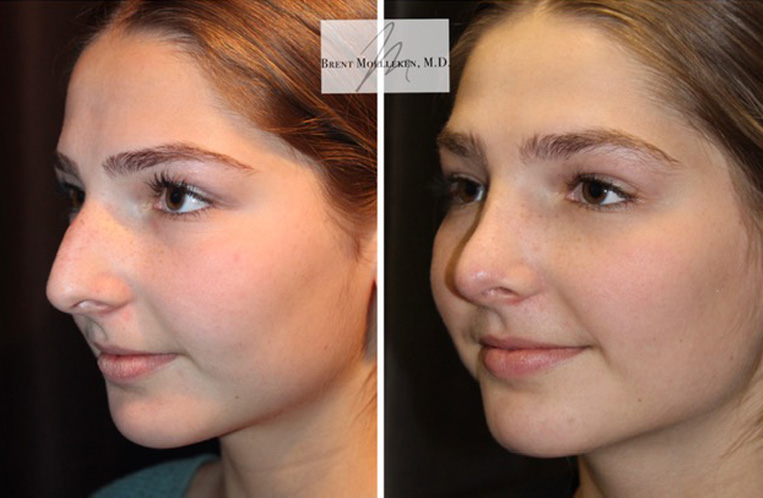 Rhinoplasty Before And After Patient 24 Case 5524 Side View