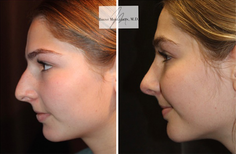 Rhinoplasty Before And After Patient 24 Case 5524 SideView