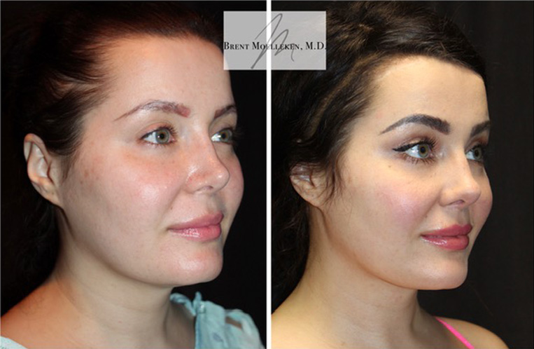 Rhinoplasty Before And After Patient 25 Case 5525 Side View