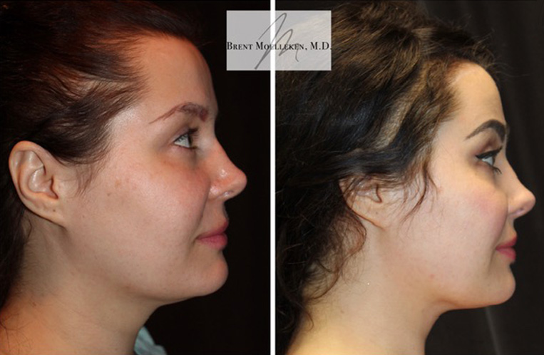 Rhinoplasty Before And After Patient 25 Case 5525 SideView