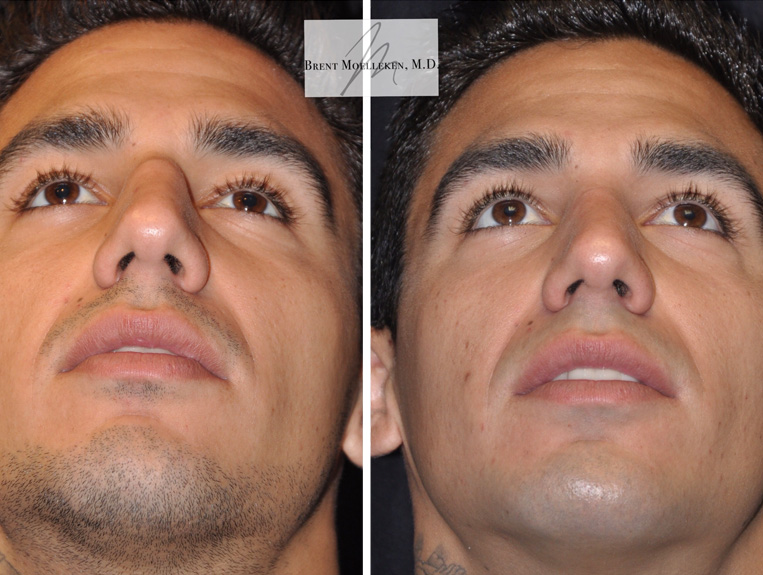 Rhinoplasty Before And After Patient 8 Case 5506 Bottom View