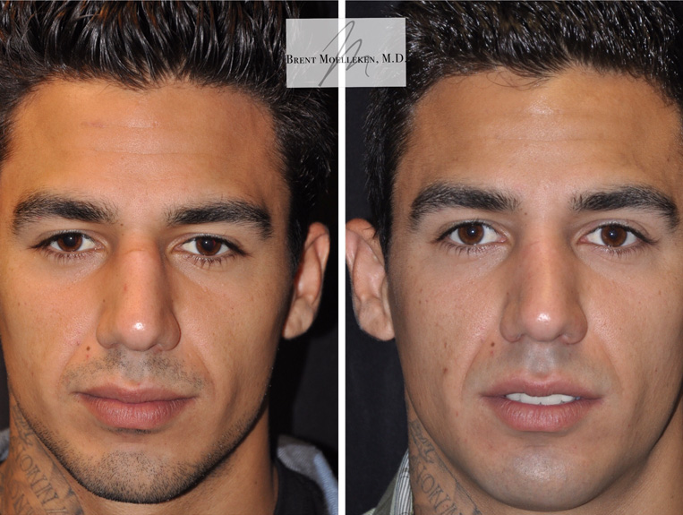 Rhinoplasty Before And After Patient 8 Case 5506 Front View