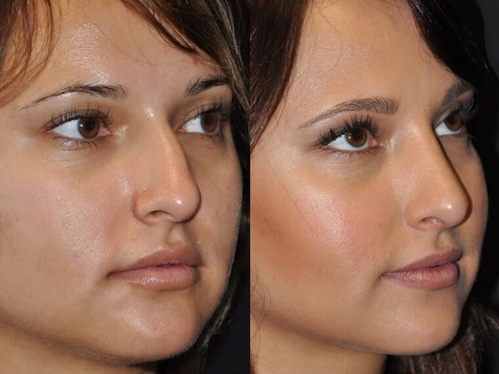 Rhinoplasty before and after patient 1 case 5520 side view