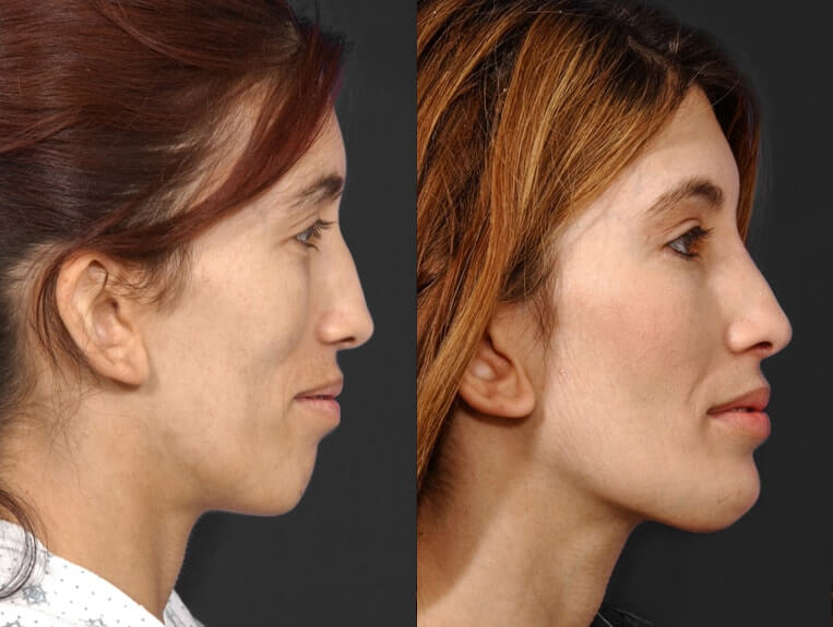 Rhinoplasty before and after patient 7 case 5444 side view 2
