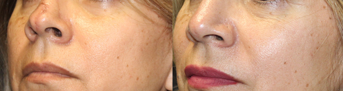 Scar revision and laser for a patient with a dog bite injury to her nose.