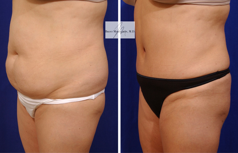 Tummy Tuck with Liposuction to Abdomen and Flanks