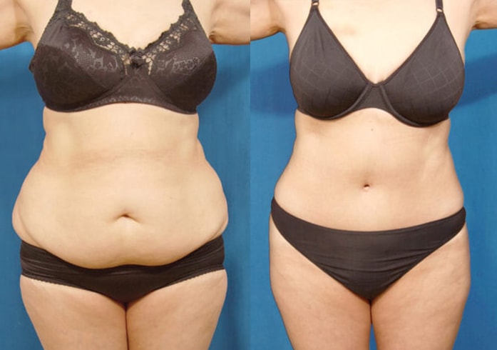Full abdominoplasty with liposculpture to flanks, abs, and waist