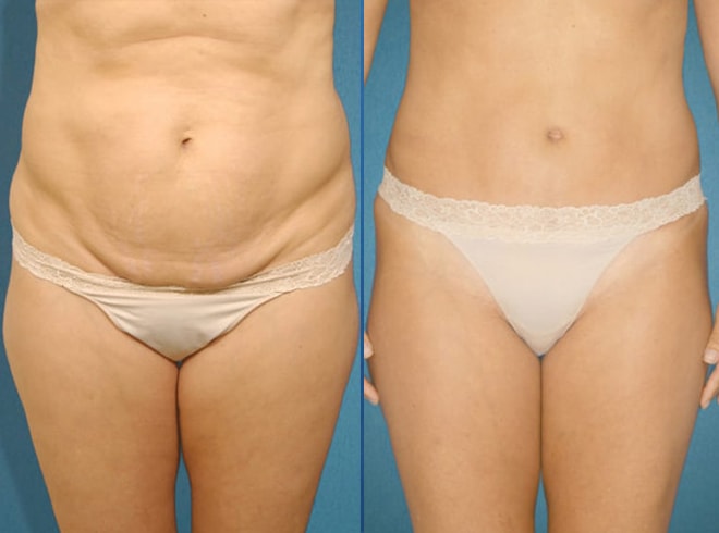 Abdominoplasty tummy tuck with liposculpture of abs and flanks