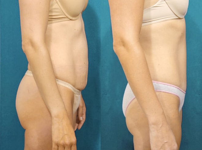 Tummy Tuck with Vertical Incision, Diastasis Repair, Liposuction to Abdomen