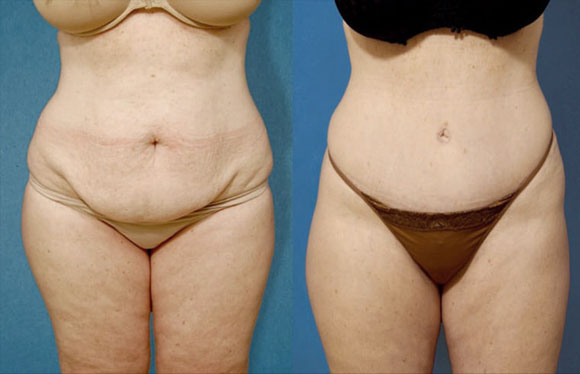 Tummy Tuck before and after patient 1