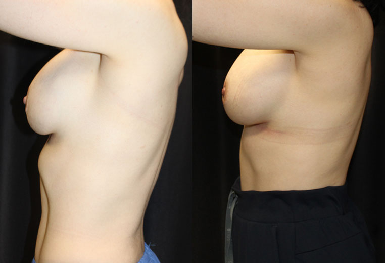 Patient had: Removal of textured implants, Capsulectomy, Capsulorraphy, Placement of new Allergan Natrielle silicone implants 345CC