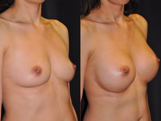 Breast augmentation before and after patient 5 case 3139 right view