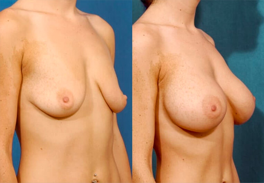 Breast augmentation with smooth saline implants, size 300cc – subpectoral placement/inframammary incision