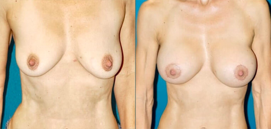 Breast augmentation with smooth saline implants, size 330cc