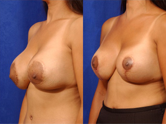 Breast and Nipple Reduction