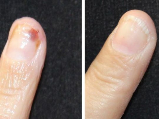 Nail bed repair with microsurgical technique