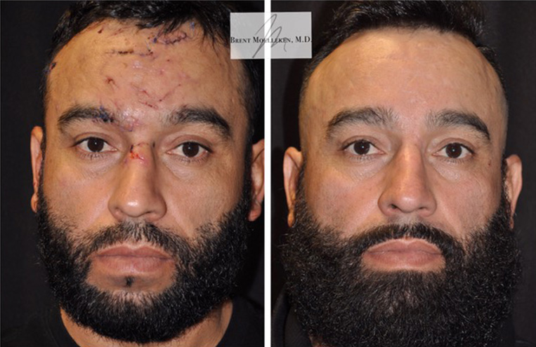 face reconstructive surgery before and after patient 1 case 5217 front view