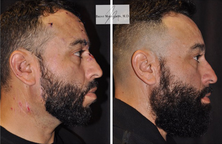 face reconstructive surgery before and after patient 1 case 5217 side view