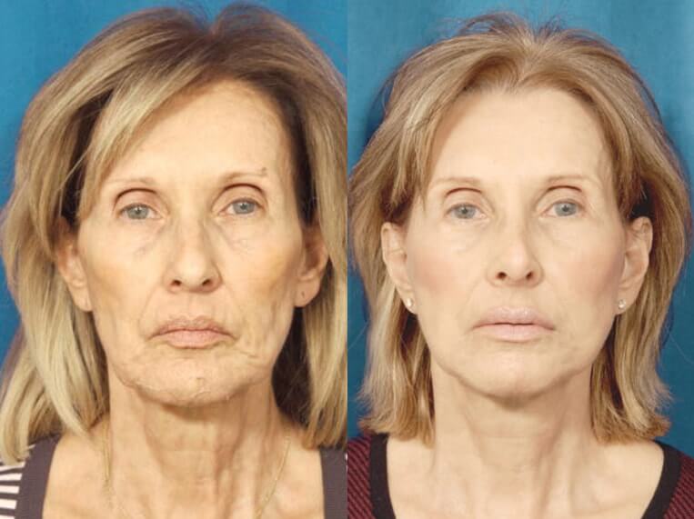 Facelift 360 Before And After Patient 1 Case 3647 Front View