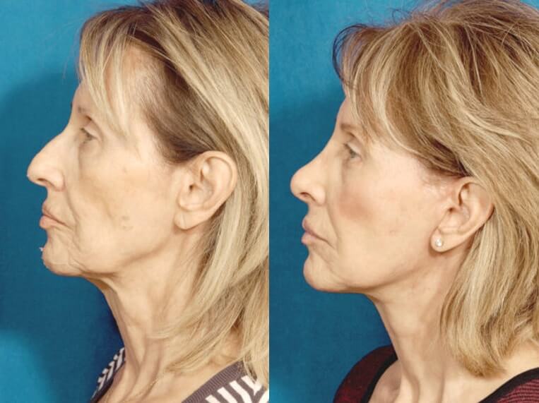 Facelift 360 Before And After Patient 1 Case 3647 Left View