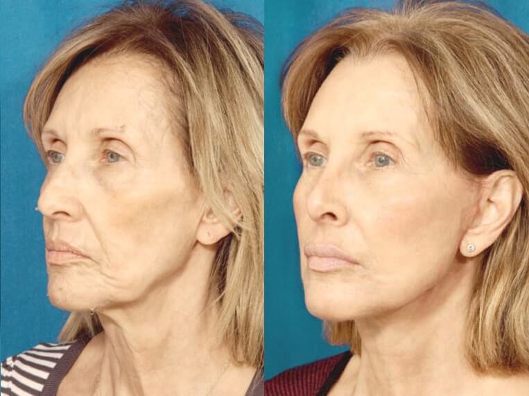 Facelift 360 Before And After Patient 1 Case 3647 3/4th Left View