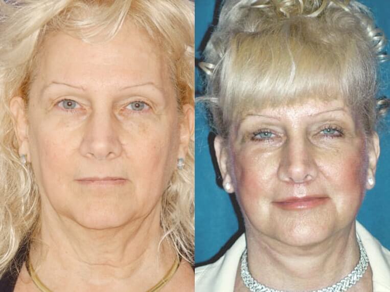 Facelift 360 Before And After Patient 2 Case 3639 Front View