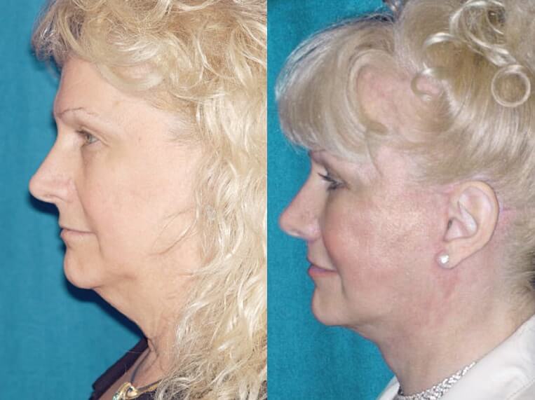 Facelift 360 Before And After Patient 2 Case 3639 Left View