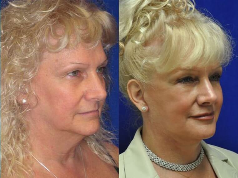 Facelift 360 Before And After Patient 2 Case 3639 Right View