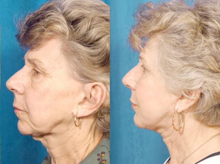 Facelift with Necklace, USIC Cheeklift, Upper Blepharoplasty, Lateral Browlift, Livefill to Nasolabial Folds and Lips, Upper Lip Lift, Co2 Laser Resurfacing