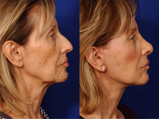 Facelift with Necklace, USIC Cheeklift, Lateral Browlift, Livefill to Naso Labial Folds and Lips, Upper Lip Lift. Rhinoplasty, Co2 Laser
