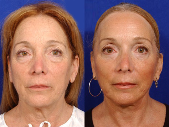 Facelift Necklace, Lateral Browlift, USIC Cheeklift, with Transconjunctival Lower Blepharoplasty, Livefill to Lips Livefill to Nasolabial Folds Co2 Laser to Face
