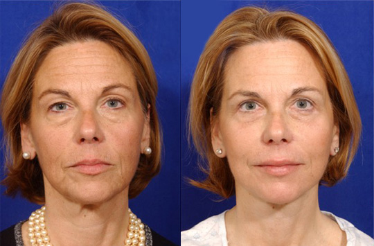 Facelift with Necklace, USIC Cheeklift, Lateral Browlift, Livefill to Naso Labial Folds and Lips, Upper Lip Lift, Rhinoplasty, Co2 to Face and Neck