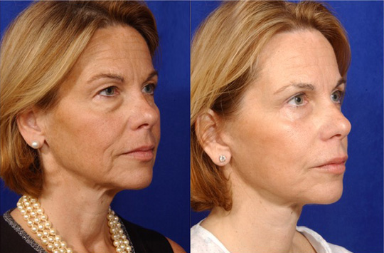 Facelift with Necklace, USIC Cheeklift, Lateral Browlift, Livefill to Naso Labial Folds and Lips, Upper Lip Lift, Rhinoplasty, Co2 Laser to Face and Neck