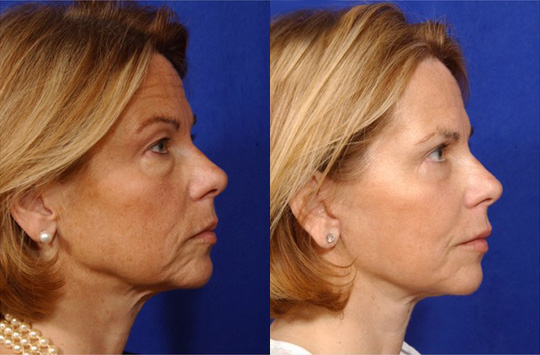 Facelift with Necklace, Lateral Browlift, USIC Cheeklift with Transconjunctival Lower Blepharoplasty, Livefill to Lips, Livefill to Nasolabial Folds, Co2 Laser to Face
