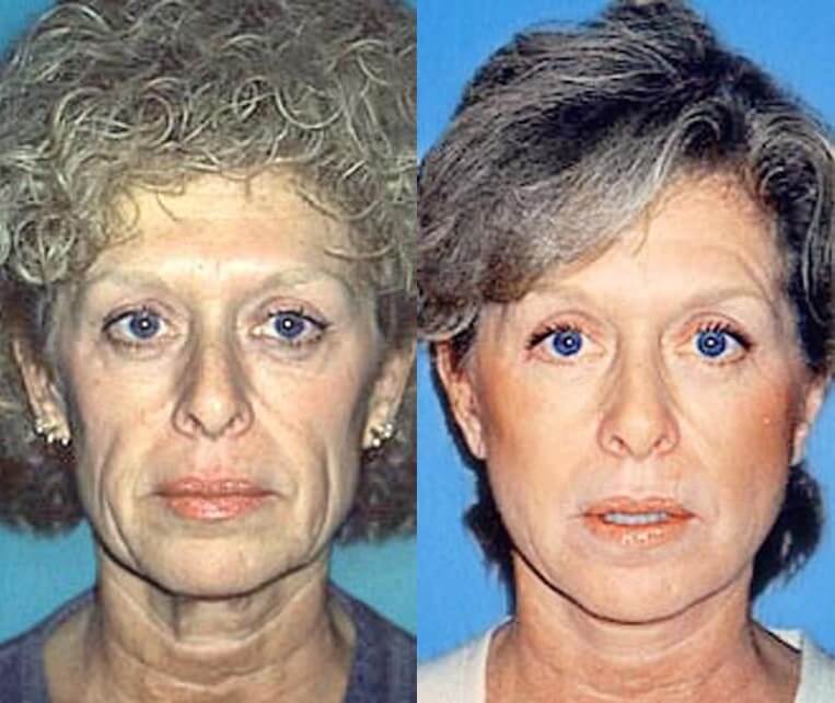 Facelift Before And After Patient 6 Case 3501 Front View