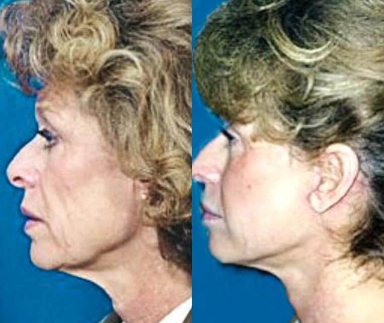 Facelift Before And After Patient 6 Case 3501 Left View