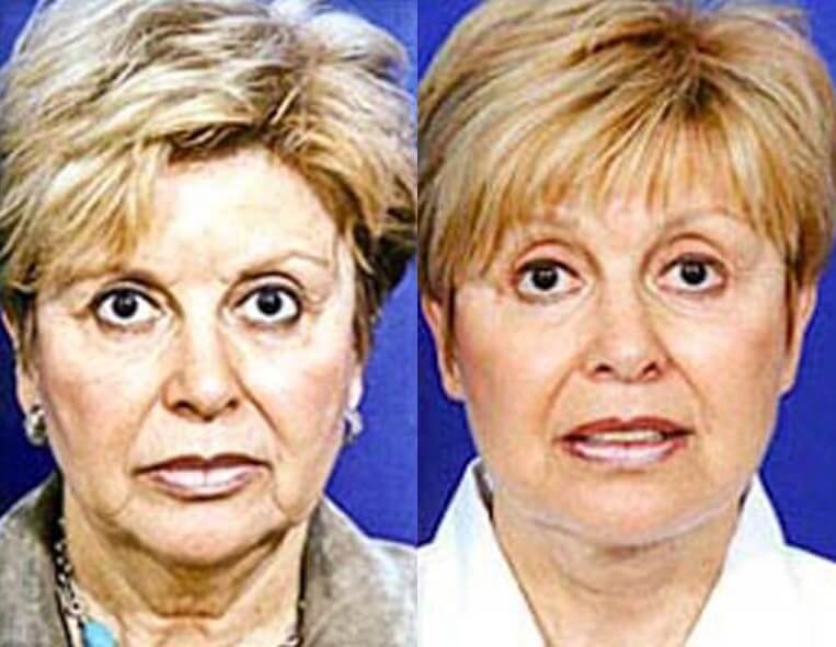 Facelift Before And After Patient 7 Case 3507 Front View