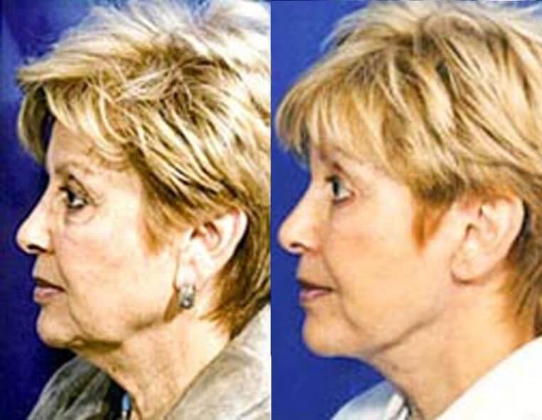 Facelift Before And After Patient 7 Case 3507 Left View