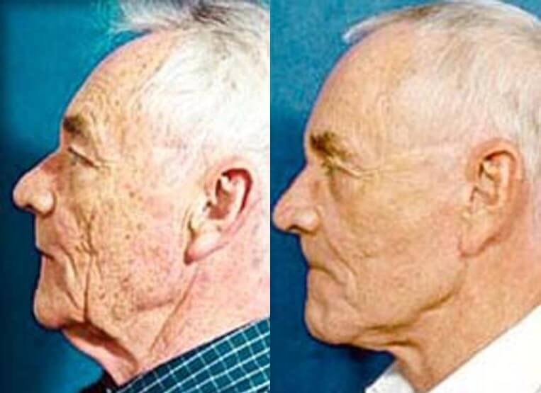 Facelift Before And After Patient 8 Case 3513 Left View