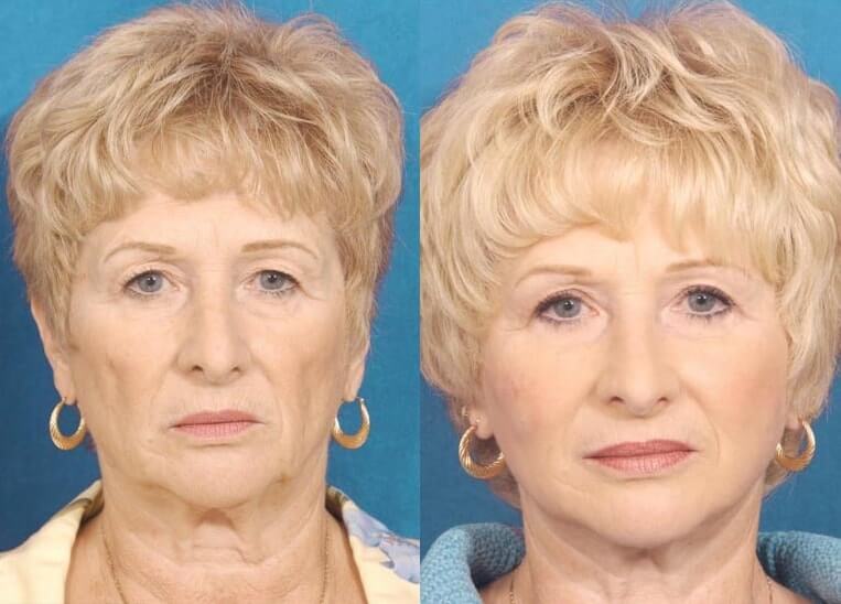 Facelift Before And After Patient 9 Case 3519 Front View