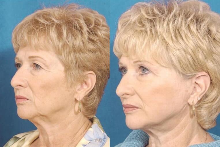 Facelift Before And After Patient 9 Case 3519 Left View
