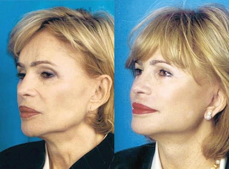 Facelift Before And After Patient 10 Case 3525 3/4th Left View
