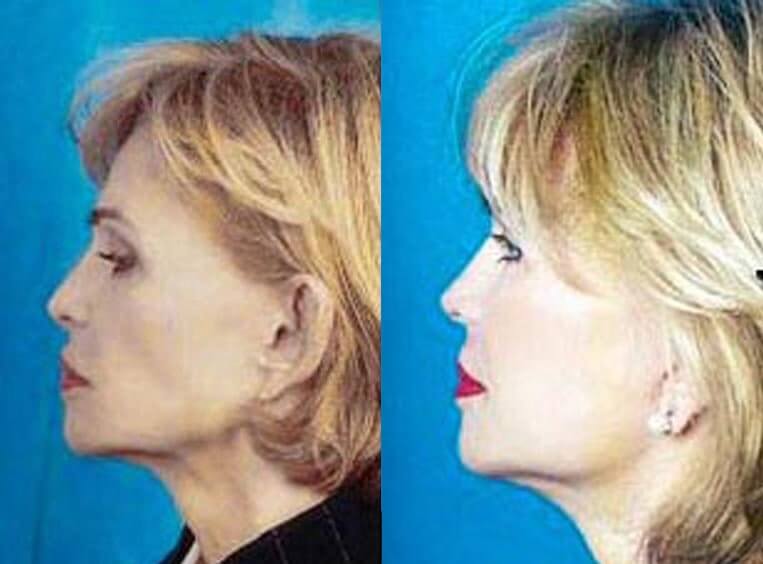 Facelift Before And After Patient 10 Case 3525 Front View
