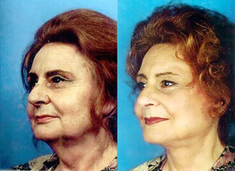 Facelift Before And After Patient 11 Case 3531 Left View
