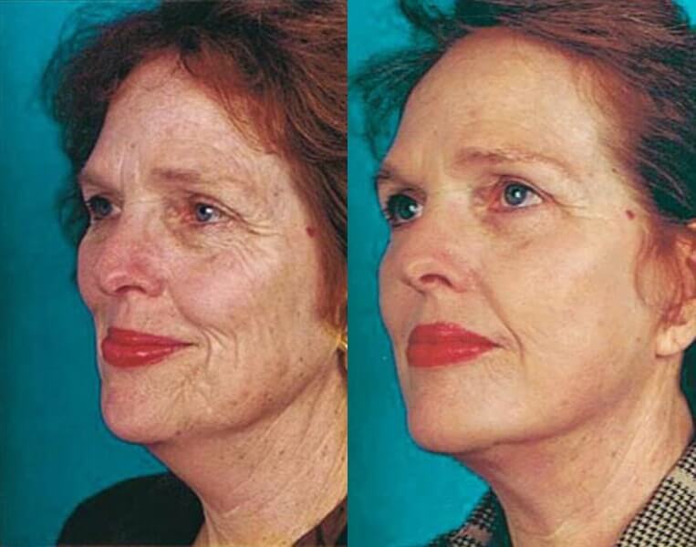 Facelift Before And After Patient 12 Case 3535 Front View