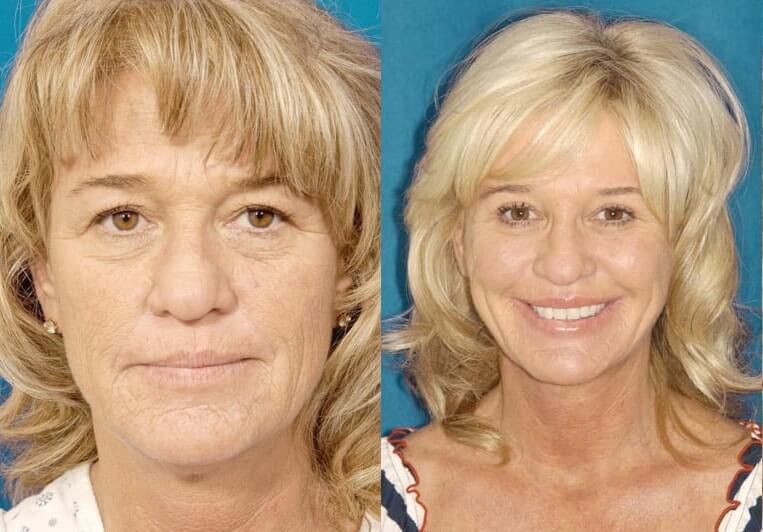 Facelift Before And After Patient 14 Case 3547 Front View