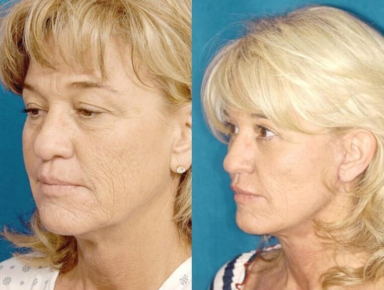 Facelift Before And After Patient 14 Case 3547 Left View