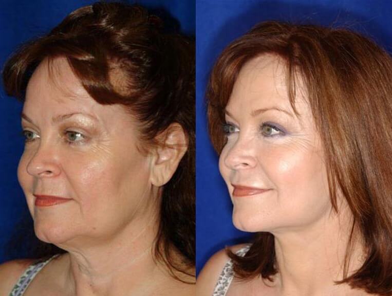 Facelift Before And After Patient 15 Case 3553 3/4th Left View